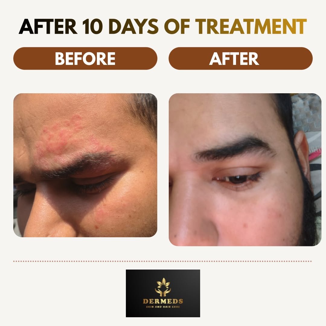 Skin Treatment Result 2